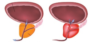 prostatit erkeklerde