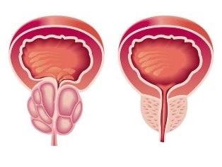 Gibi görünüyor prostatit