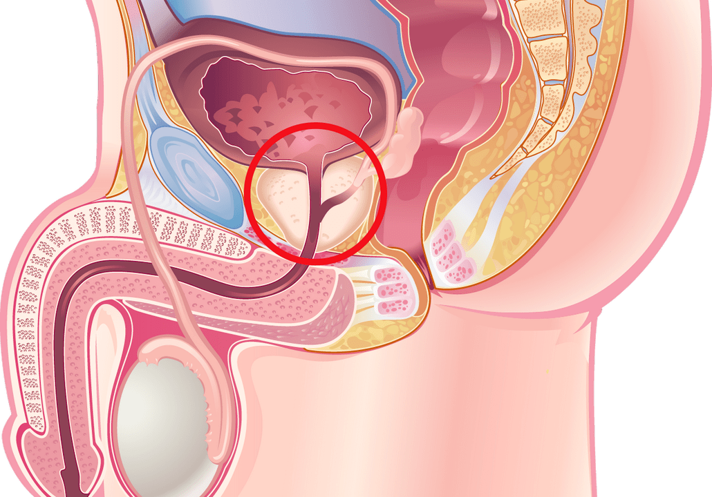 prostatit belirtileri ve belirtileri