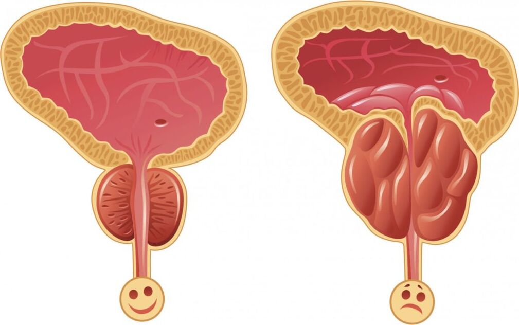 erkeklerde prostatit belirtileri